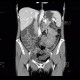 Aortomesenteric compression, SMA syndrome, superior mesenteric artery: CT - Computed tomography